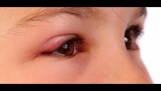 كيفية علاج انتفاخ العين