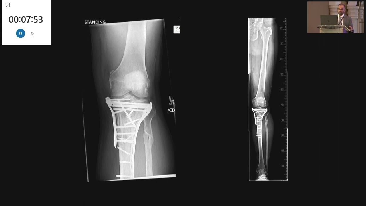 TKR in a patient with retained metal work by Dr. Amir Qureshi