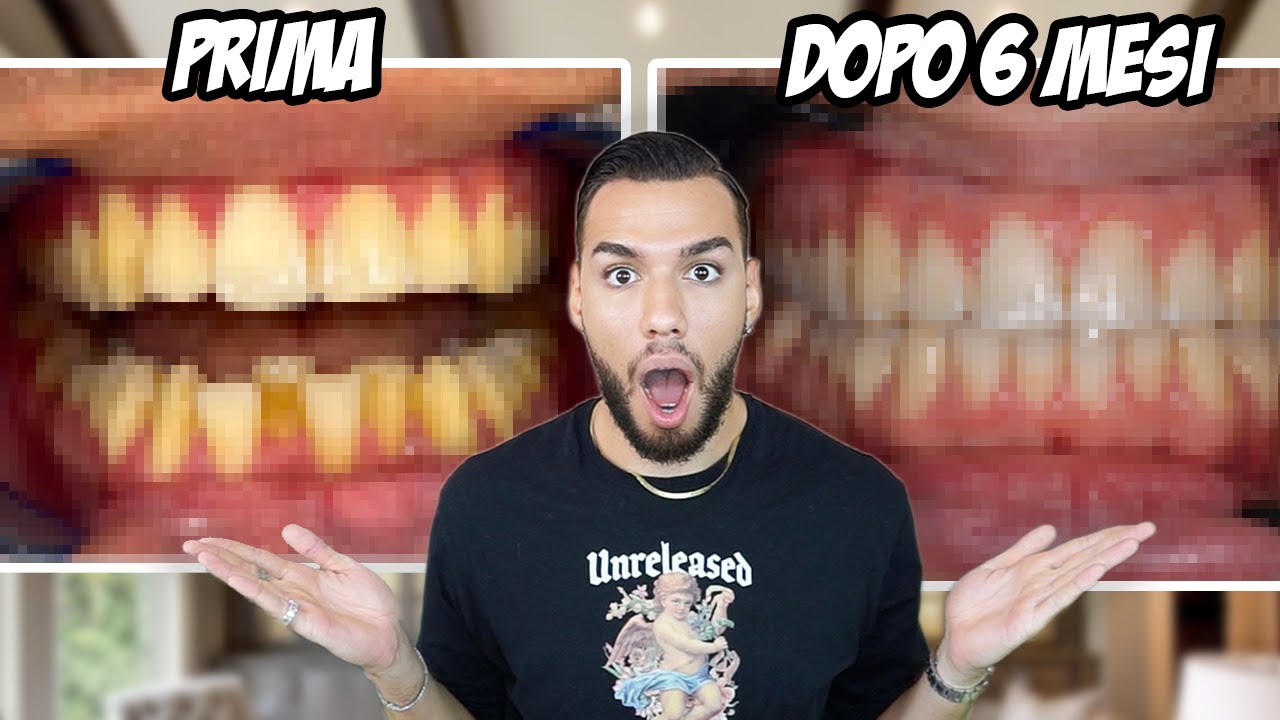 PRIMA E DOPO INVISALIGN IN 6 MESI... *con foto e video PRIMA E DOPO*