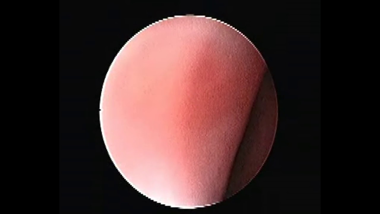 diagnostic nasal endoscopy YouTube