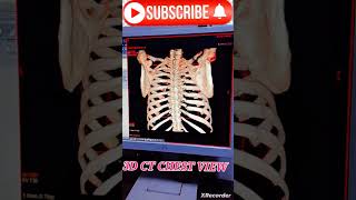 3D Ct Chest View