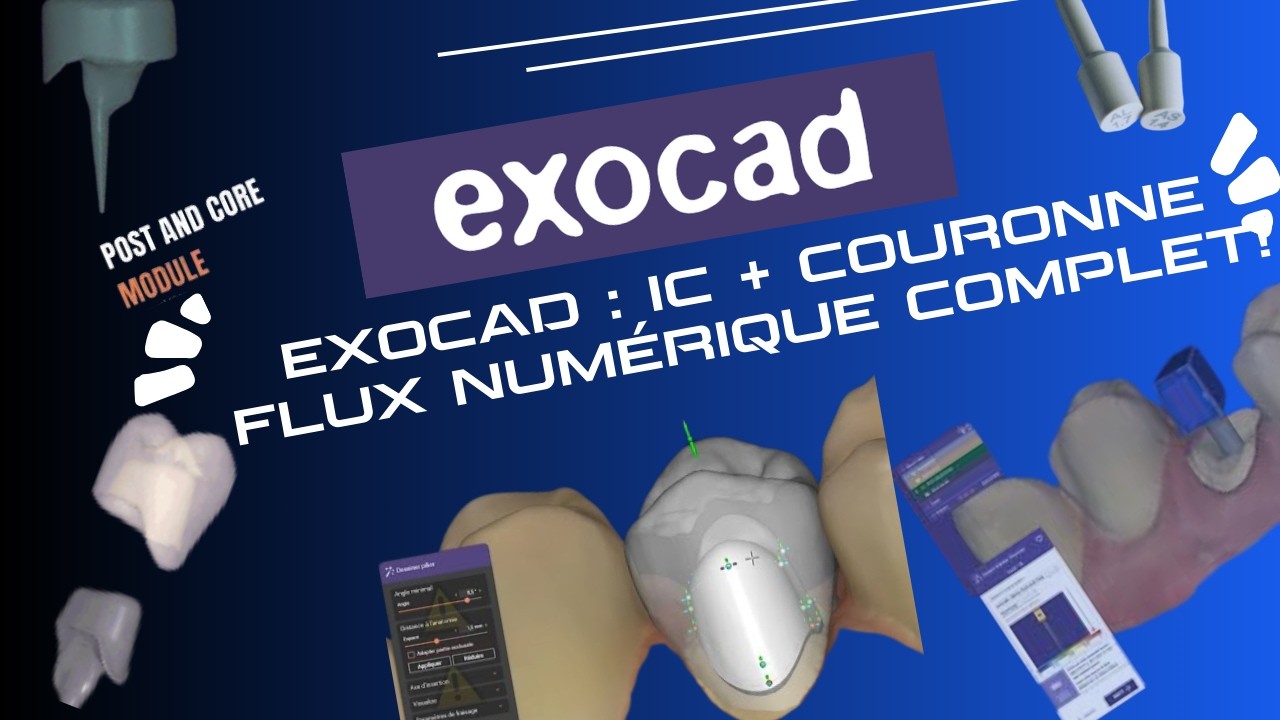 Exocad : IC + Couronne. Flux numérique complet!