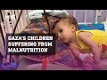 Children in Gaza suffering from malnutrition