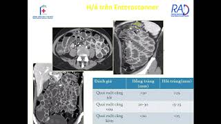 CLVT Ruột non + Đại Tràng - YHN News