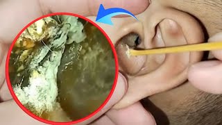 Horror: Clean dry earwax in the ear canal, infected ear canal | ASMR | EP 180