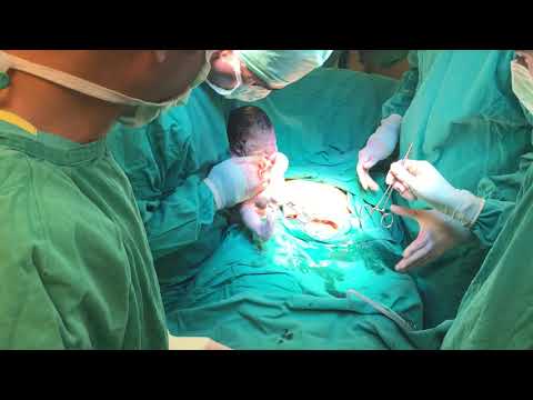 Sezaryen doğum ameliyatı