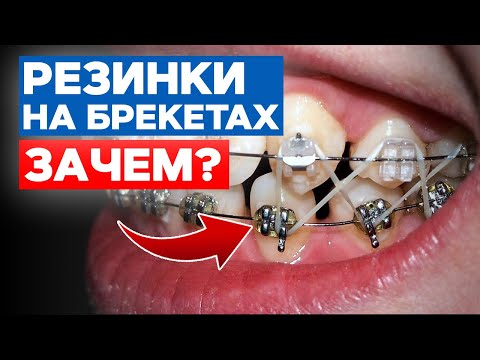 Зачем нужны ЭЛАСТИКИ? | Сколько носить резинки с брекетами?