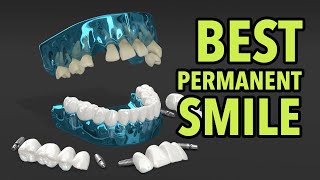 Patients Choosing 3 on 6 vs All-on-4 | Dental Implants and Bridges Smile Restoration in Utah