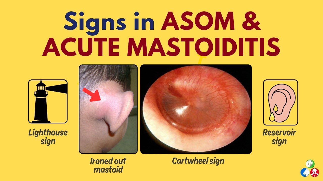 Signs in ASOM, Acute Mastoiditis| Cartwheel sign, Lighthouse sign ...