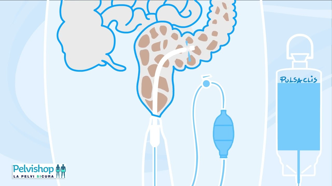 PULSACLIS - "Clistere a getto pulsante"