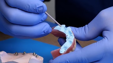 Section A: Preparation | Chapter 2: Locating Abutments - Smart Denture Conversions Training