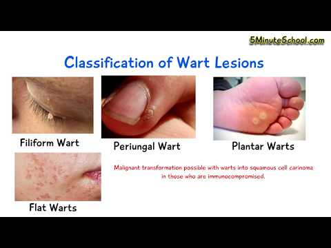 What is a Wart? (Human Papilloma Virus) EXPLAINED IN 3 MINUTES! Cause Diagnosis CLASSIFICATION