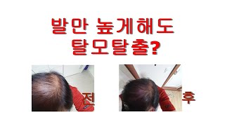 탈모고민 탈출
