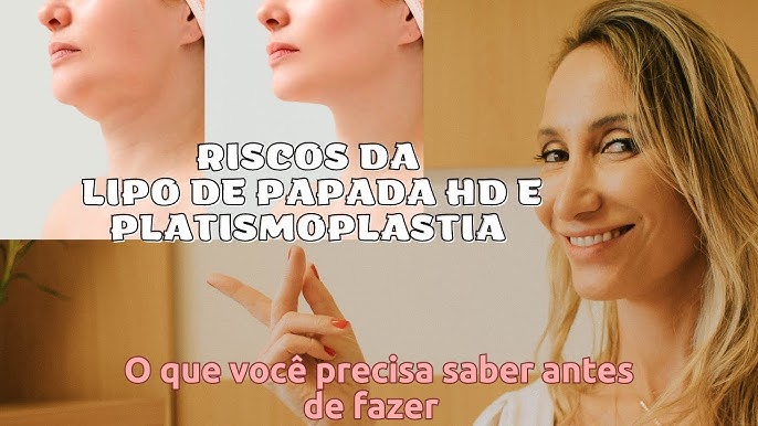 Lipo de Papada HD e Platismoplastia. O que tem de melhor para o