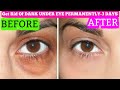 How to get rid of Puffy Eyes | How to Remove Wrinkles | How to Remove Dark Circles Only in 3 days