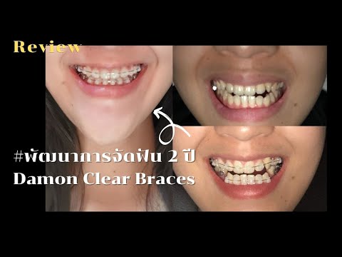 รีวิว พัฒนาการของการจัดฟันแบบดาม่อน เคลียร์ (Damon System braces)