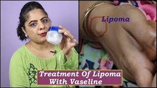 मैंने गाँठ(Lipoma)को Vaseline(Petrolium Jelly) से कैसे ठीक किया?  My Own Experience-Aapki saheli