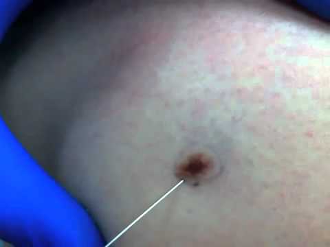 Scoop Shave Biopsy long version.mp4