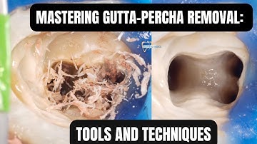 Clinical Tips for easy Gutta-Percha Removal | Endodontic Retreatment