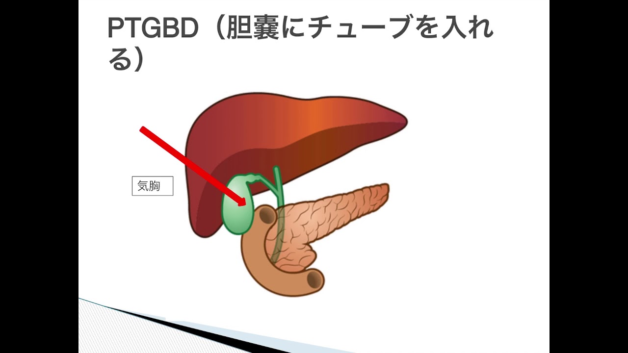 胆道系の処置について　フルバージョン