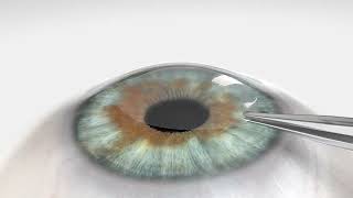 Zeiss Smile Pro Animation Video See How The Procedure Works Kelly Vision