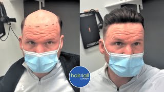 Before & After | Hair System | Non-Surgical Hair Replacement System Men/Women | UK/USA/International