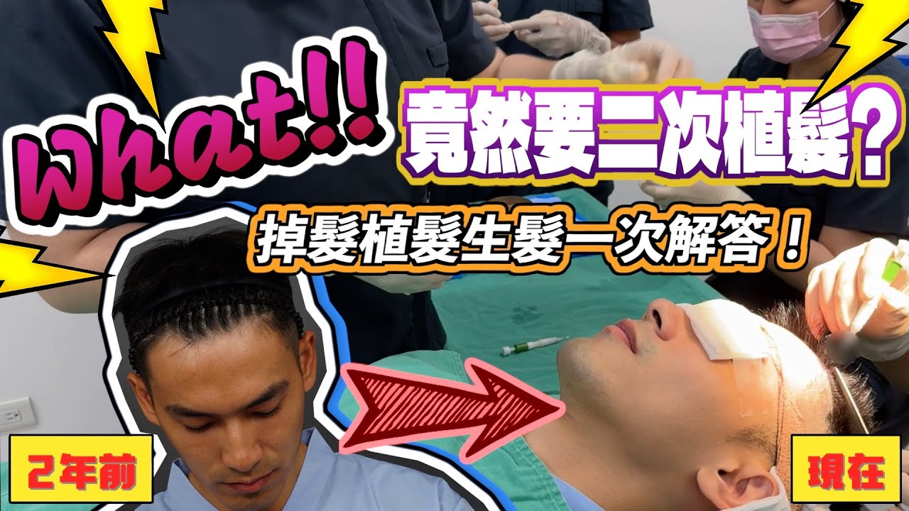 是什麼很差的人竟需要二次植髮？雄性禿、落髮生髮教你如何照顧！【雅各Jacob】