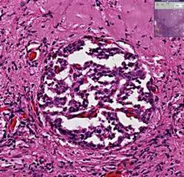 Histopathology Pancreas --Islet cell tumor (insulinoma)