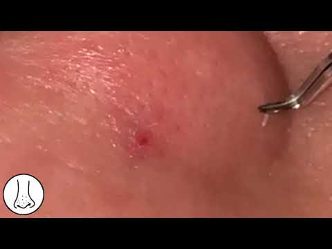06satisfied Blackhead Removal With Tweezer Close Up黒ニキビ角栓除去清除黑頭粉刺여드름제거cara Menghilangkan Komedo Youtube