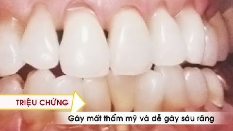 Phòng và điều trị mòn răng