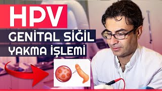 Hpv Genital Siğil Yakma İşlemi