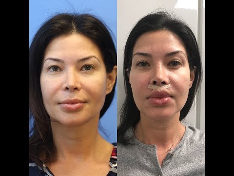Edgewater, NJ | LIP LIFT - Bullhorn Technique | The Kaplan ...