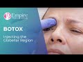 Injecting the Glabellar Region   BOTOX