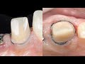 Dental basics: Gingival Retraction - The two cord technique