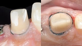 Dental basics: Gingival Retraction - The two cord technique screenshot 2