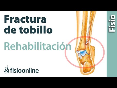 Rehabilitación de fracturas de tobillo con ejercicios, automasajes y estiramientos