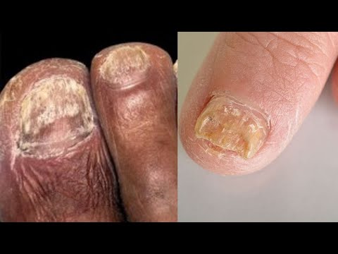 فطريات أظافر القدم الأسباب والأعراض والعلاج