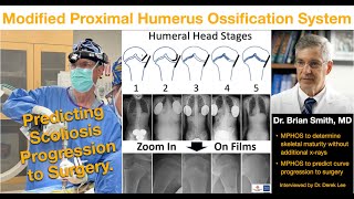 Dr. Brian Smith, MD: Modified Proximal Humerus Ossification System for Skeletal Maturity & Scoliosis