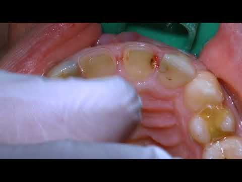 Video: Zahnkronenprothetik