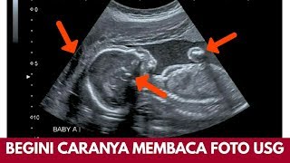 Cara Membaca hasil USG yang bisa dipelajari Ibu Hamil