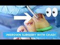 STEP BY STEP INGROWN NAIL REMOVAL WITH CHAD!