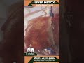 Fatty Liver क्या है, फैटी लिवर: कारण, निदान और उपचार #ayurvedictreatments #fattyliver #health