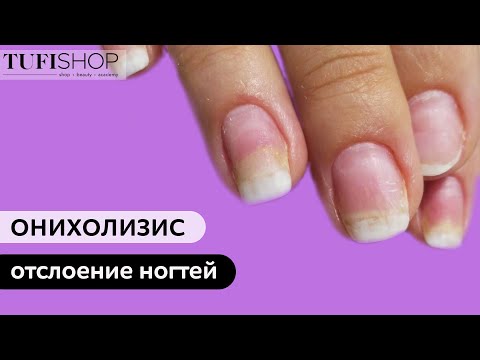 ОНИХОЛИЗИС (отслоение ногтей)