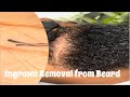 Satisfying Removal of Ingrown|Compound Hairs!!!