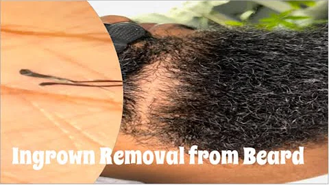 Satisfying Removal of Ingrown|Compound Hairs!!!