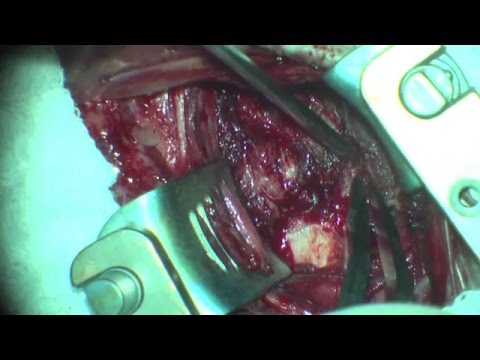 Cirurgia Hérnia de Disco