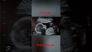 nt scan in pregnancy