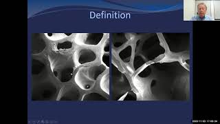 Osteoporosis: Prevention, Treatment & Management