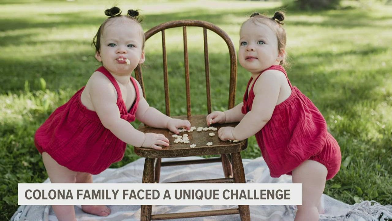 Iowa doctor treats Colona twins born with club feet without surgery