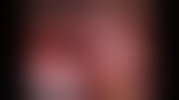 Fissureless Robotic Right Lower Lobectomy with step-by-step narration